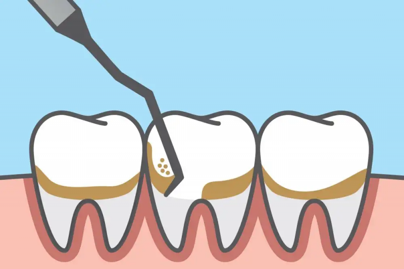Irving Scaling Root Planing Kids & Grownups Dental
