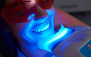 Professional vs. At-Home Teeth Whitening: Your Guide