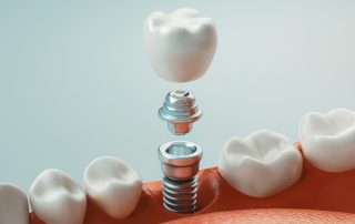 Dental Implants vs. Dentures: Which is Right for You?
