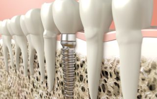 Rediscover the Joy of Eating with Dental Implants