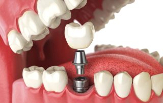 Reclaim Your Smile: The Power of Dental Implants