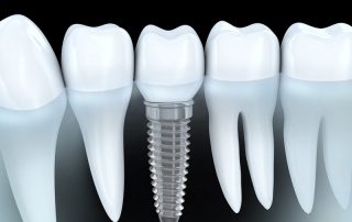 Can Dental Implants Get Cavities? Facts You Should Know