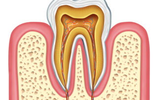 Signs You Need a Root Canal Treatment Now