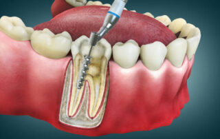 Root Canal Myths Debunked: The Real Truth